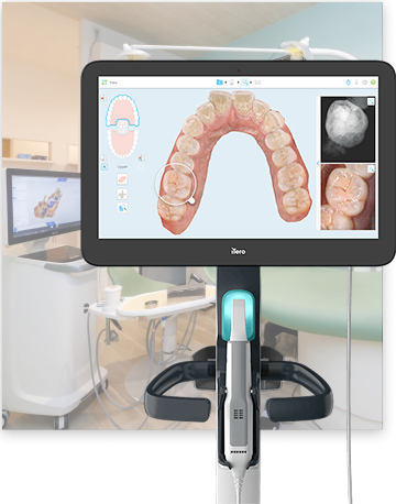 光学スキャナー（iTero）による精密な型取り